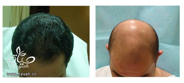 زراعة الشعر بطريقه الإقتطاف - fue hayahcc_1367672434_477.jpg