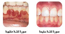 لعلاج التهاب اللثة hayahcc_1426091656_694.jpg